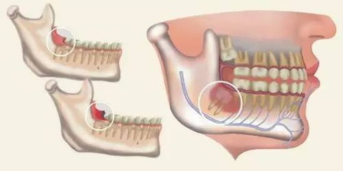 智齒切肉注意事項