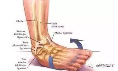 崴腳打石膏后注意事項