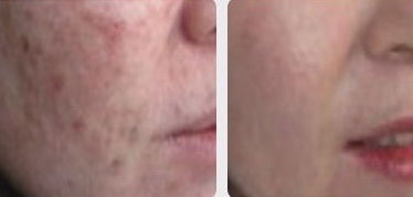 激光祛疤后注意什么,做完疤痕激光手術(shù)注意事項(xiàng),做完激光祛斑注意事項(xiàng)