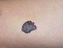 去黑痣后注意事項(xiàng),點(diǎn)完黑痣注意事項(xiàng),激光去黑痣后注意事項(xiàng)