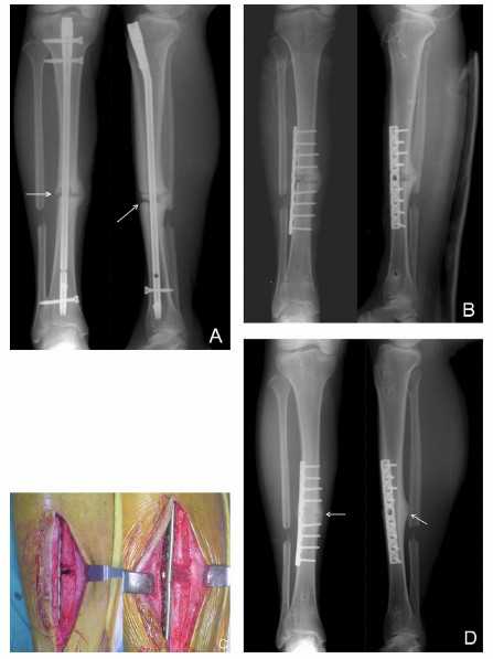 脛骨骨折手術(shù)后注意事項,脛骨截骨術(shù)后注意事項,脛骨取鋼板后注意事項