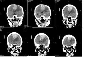 腦膜瘤術(shù)后飲食注意事項(xiàng)
