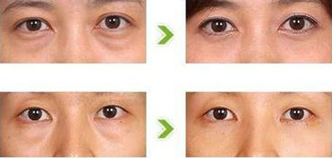 眼袋手術(shù)術(shù)后注意事項(xiàng)