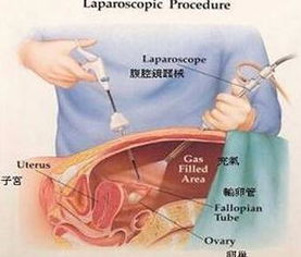 輸卵管造影術(shù)前注意事項(xiàng)