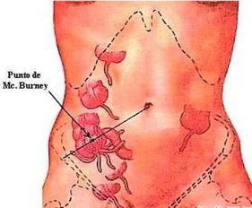 得了闌尾炎注意事項(xiàng)