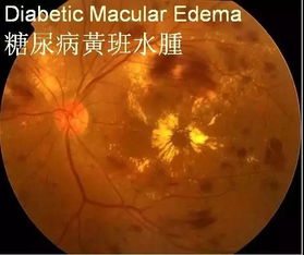 有什么,黃斑,水腫,注意事項