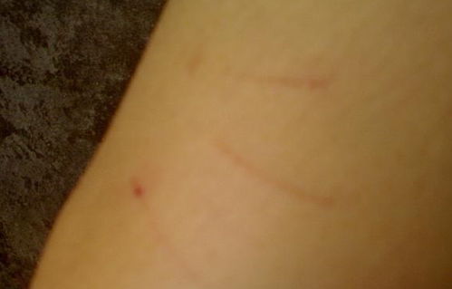 被貓抓傷注意事項