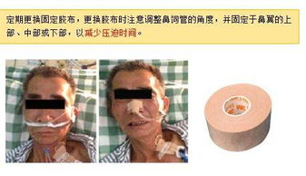 胃管的操作及注意事項(xiàng),胃管的注意事項(xiàng)和護(hù)理,留置胃管的注意事項(xiàng)