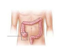 闌尾炎,注意事項(xiàng)