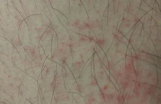 毛囊炎與疥瘡的注意事項(xiàng)