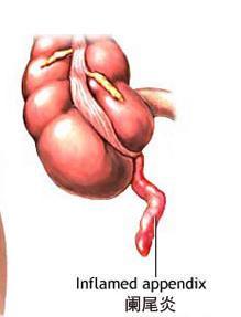 闌尾炎吊水后注意事項