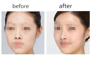 鼻孔縮小手術(shù)注意事項