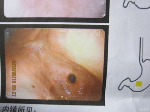 胃炎,術(shù)后,注意事項