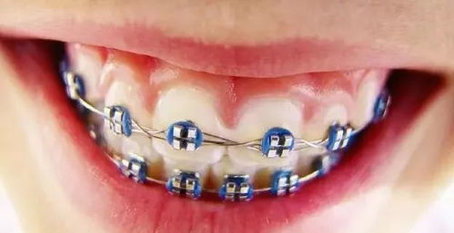 牙套注意事項,戴牙套的注意事項,剛戴牙套注意事項