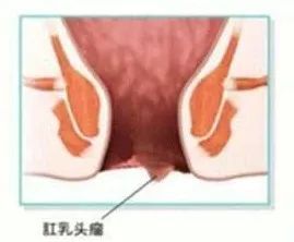 肛乳頭肥大結(jié)扎術(shù)后注意事項(xiàng)