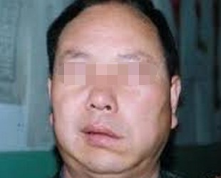 面癱好了以后需要注意什么,面癱治愈后應(yīng)注意什么,面癱痊愈后注意事項(xiàng)