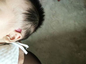 激光血管痣后注意事項