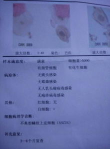 tct檢查之前注意事項