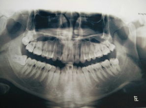 拔立事牙前注意事項(xiàng)