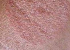 體癬應注意事項