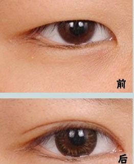 武漢韓式雙眼皮術(shù)后注意事項