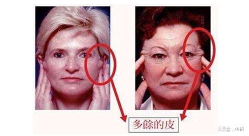 拉皮手術(shù)術(shù)后注意事項(xiàng)