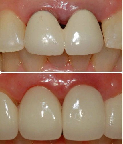 修復(fù),注意事項,烤瓷牙