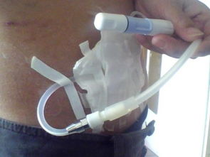 透析,用藥,注意事項(xiàng),患者