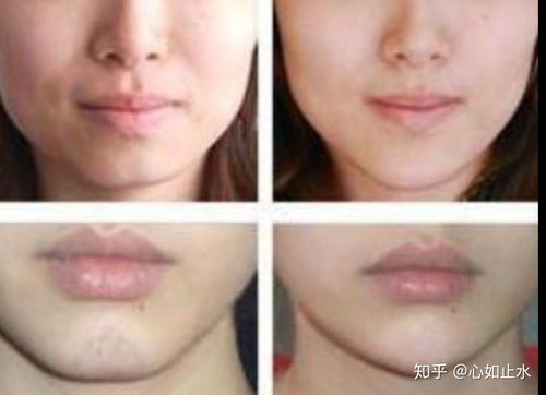 隆下巴術(shù)后注意事項(xiàng)