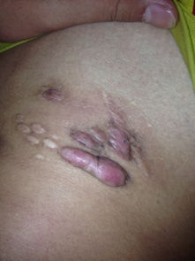 闌尾炎開刀注意事項