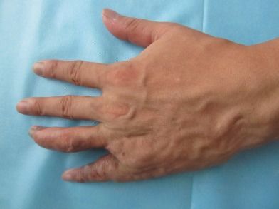 靜脈血管瘤術(shù)后注意事項(xiàng),血管瘤飲食注意事項(xiàng),血管瘤手術(shù)后注意事項(xiàng)