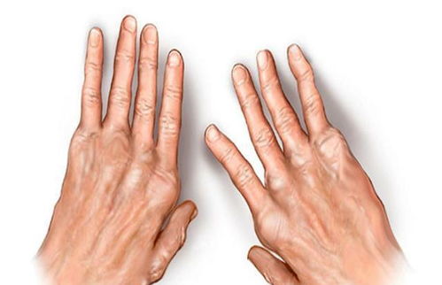 腿部風(fēng)濕注意事項(xiàng)