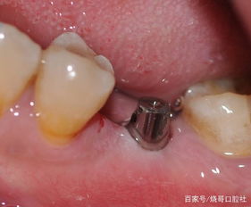 牙植骨要注意事項