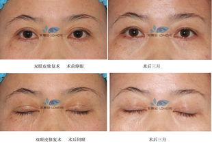 眼睛動手術(shù)注意事項