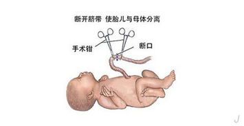 舌臍帶手術注意事項