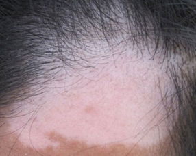 男性白癜風(fēng)注意事項(xiàng)