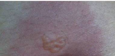 壓瘡的分期和注意事項(xiàng)