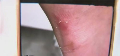 腳踝磕破縫針后注意事項