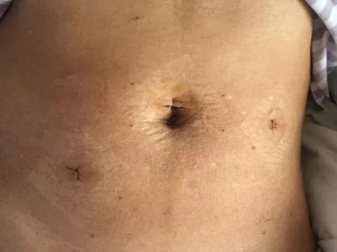 腹腔鏡疝氣修補(bǔ)術(shù)后的注意事項(xiàng)