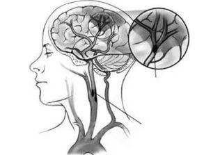 腦梗注意事項(xiàng)大全