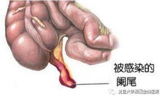 闌尾炎,開刀,注意事項