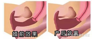 緊縮,術(shù)后,陰道,注意事項