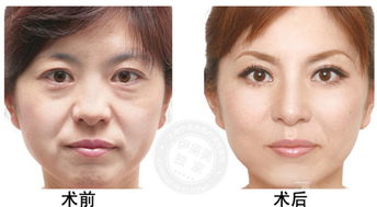 注射,膠原蛋白,注意事項,除皺