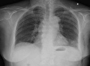 胸腺癌放化療注意事項(xiàng)