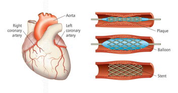 心臟補(bǔ)洞后注意事項(xiàng)