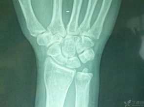 骨折手術(shù)后注意事項有哪些,骨折手術(shù)拆線后注意事項,脛骨骨折手術(shù)后注意事項