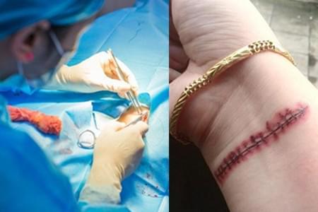 手術(shù)縫針拆線注意事項