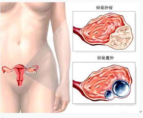 手術后,注意事項,卵巢癌