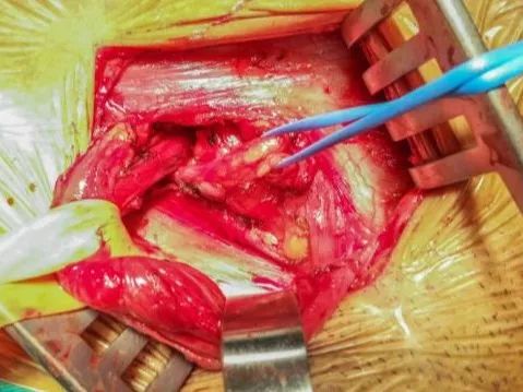 腹腔鏡疝氣手術(shù)后注意事項(xiàng),做完腹腔鏡疝氣手術(shù)后注意事項(xiàng),小兒腹腔鏡疝氣手術(shù)后注意事項(xiàng)