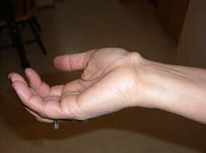 84囊腫飲食注意事項(xiàng)